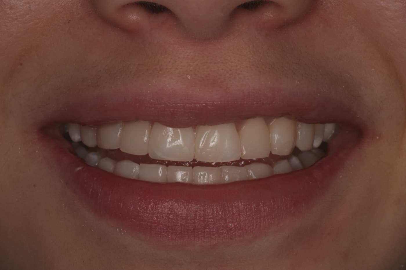 Sonrisa de paciente después de carillas de resina inyectada